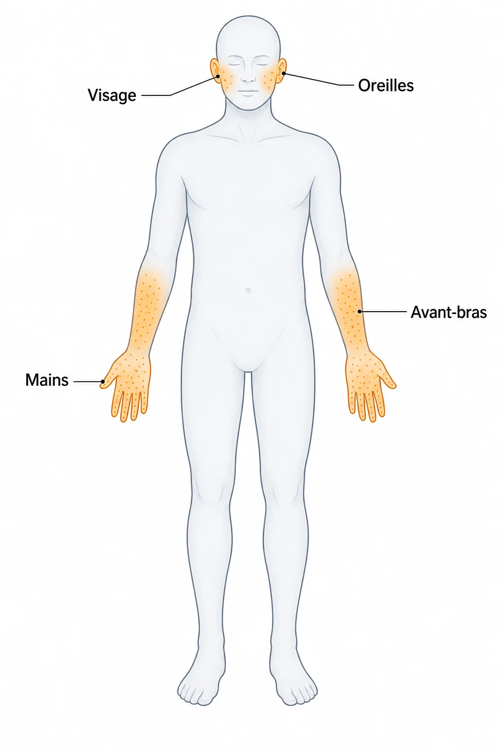 Illustration des zones de paresthésie (picotements) causées par la bêta-alanine : visage, oreilles, mains et avant-bras